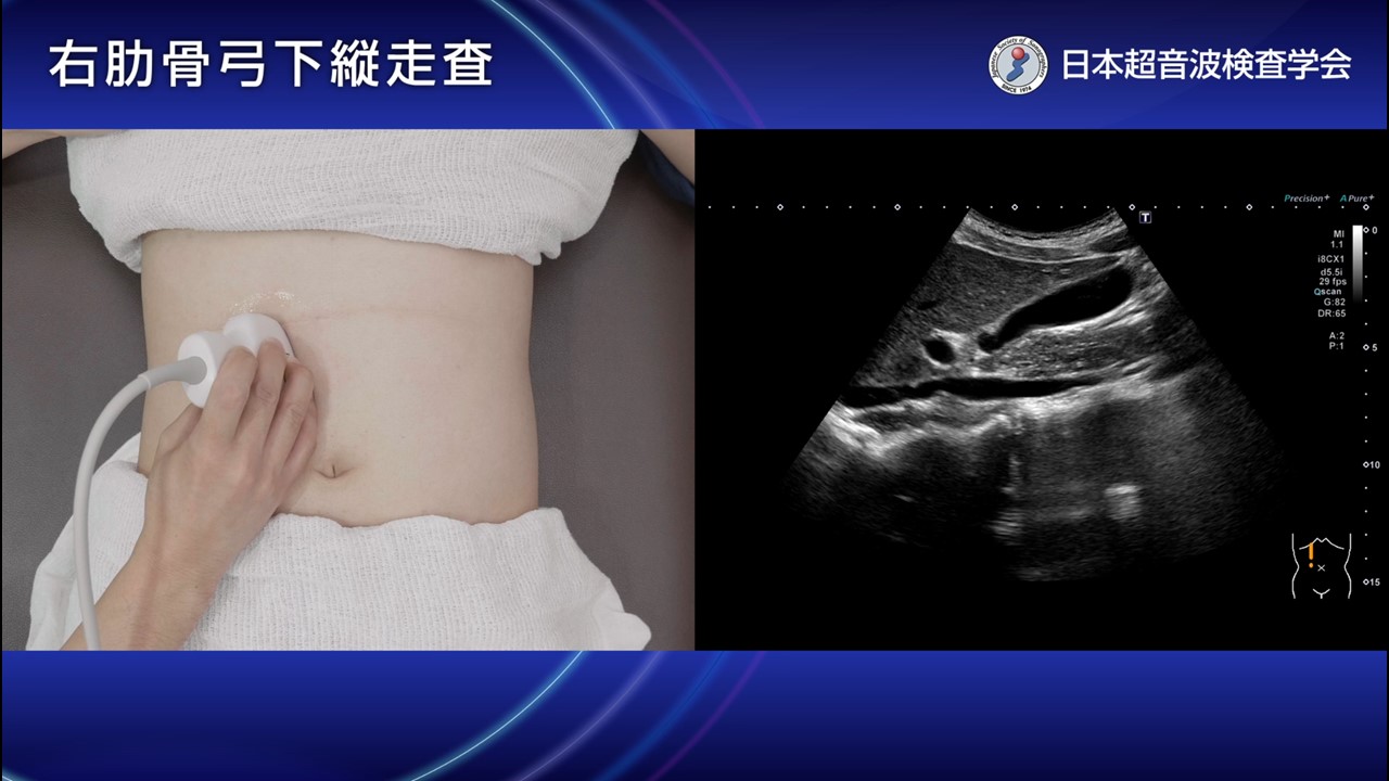 05. 右肋骨弓下（右季肋部）縦走査