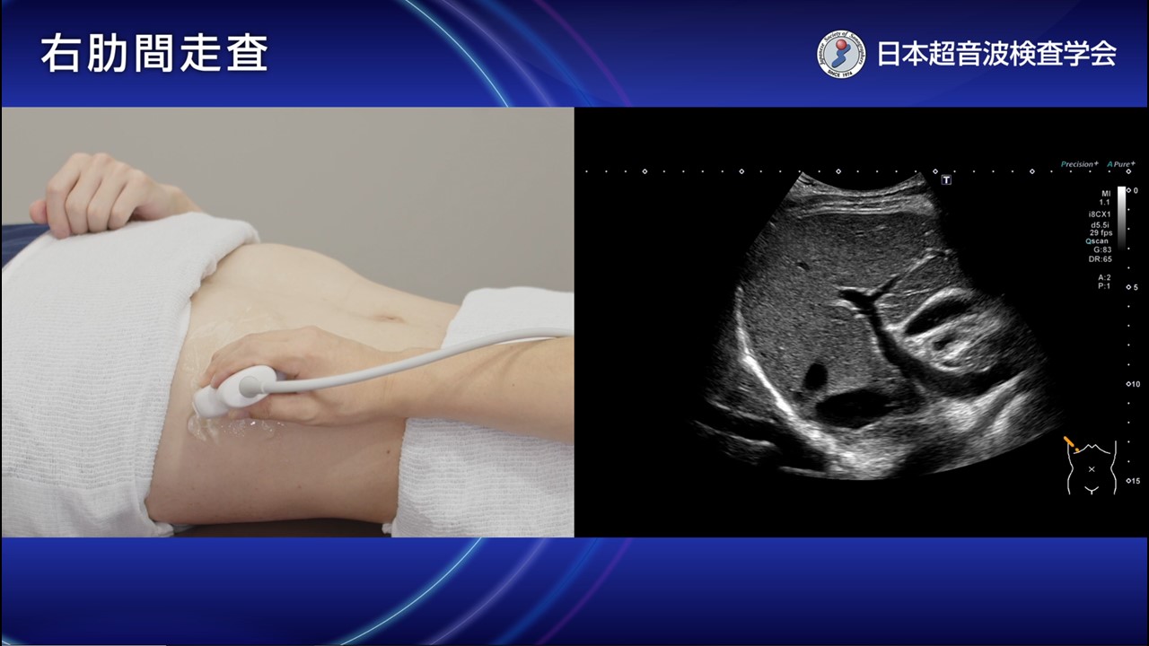 08. 右肋間走査