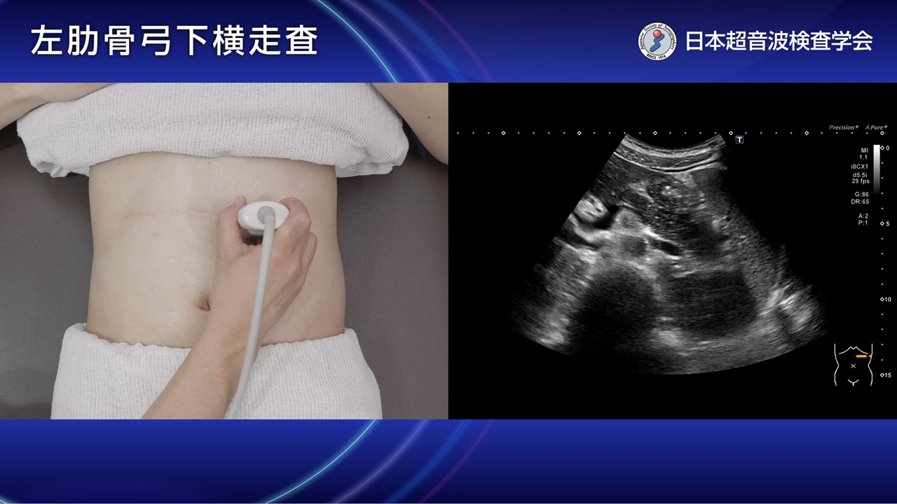 12. 左肋骨弓下横走査
