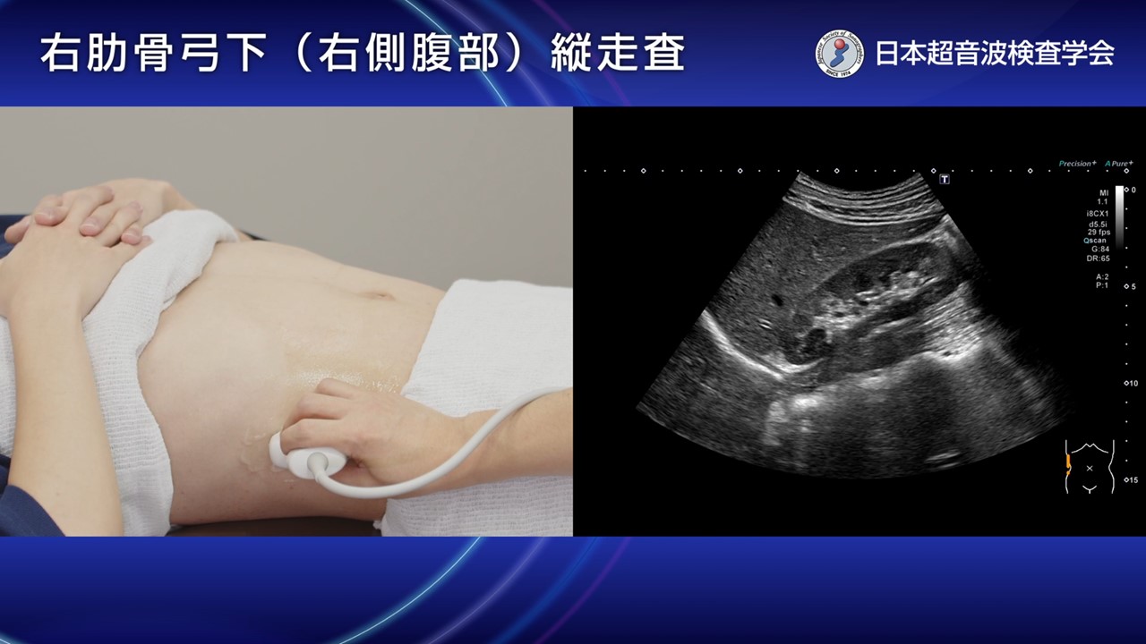 13. 右肋骨弓下（右側腹部）縦～横走査
