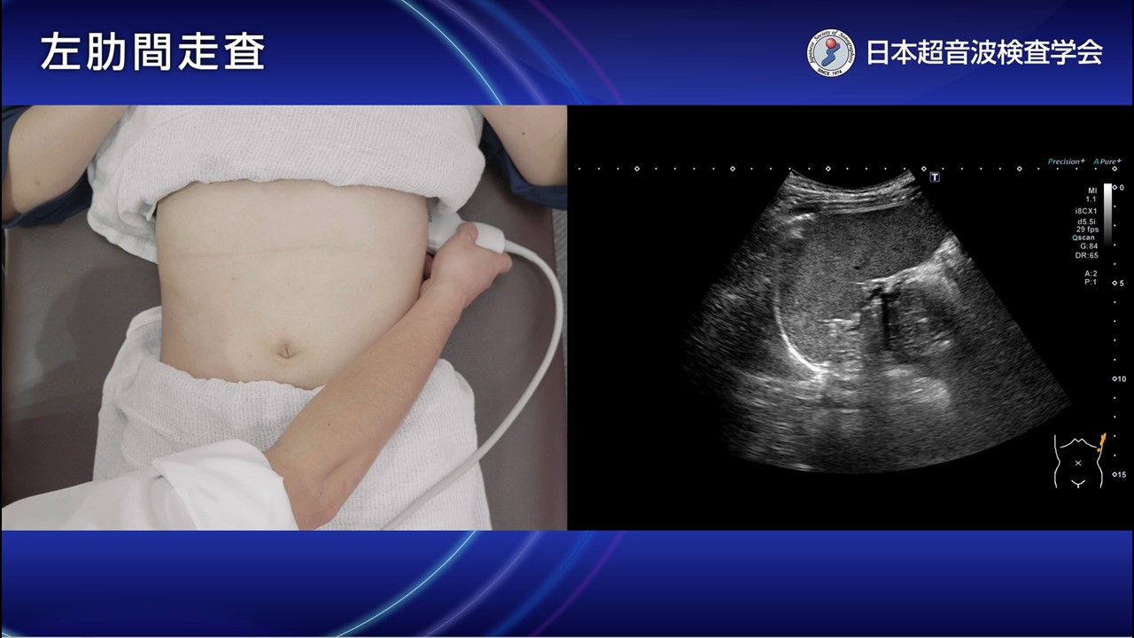 01. 左肋間走査