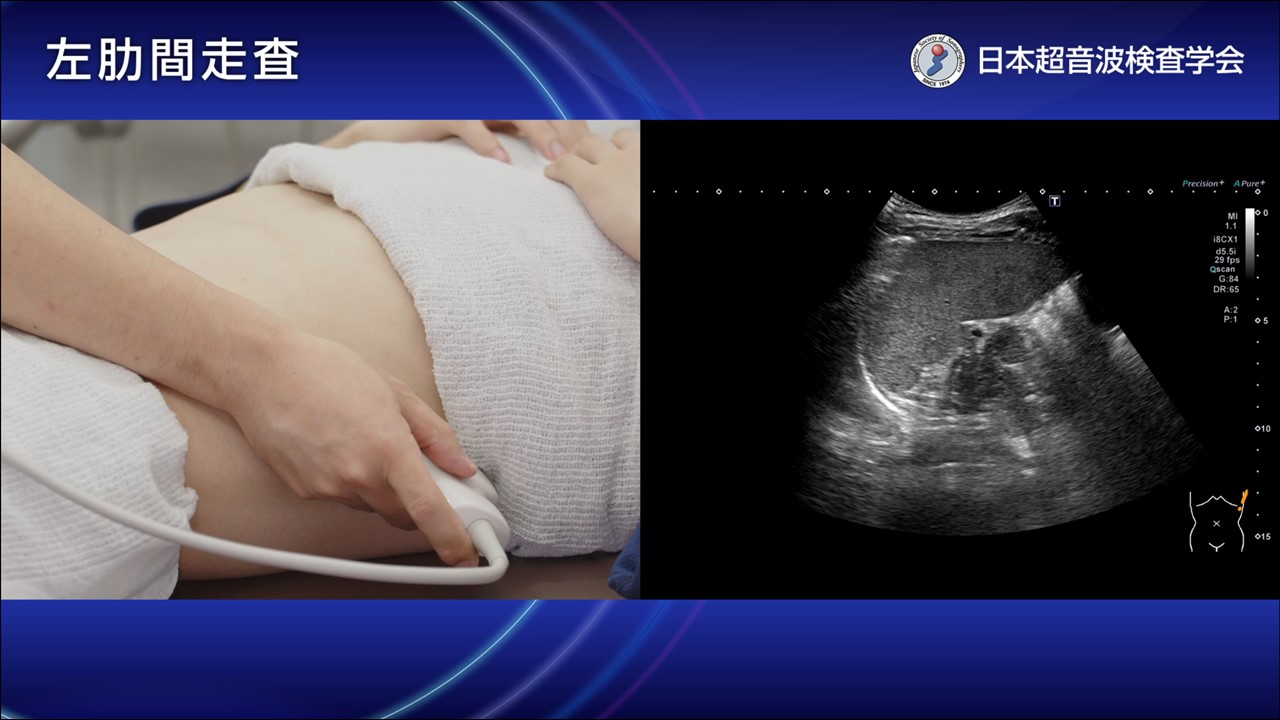 胆膵・肝臓 超音波アトラス パッと出してすぐわかる 胆・膵 超音波アトラス | 西田 睦 |本